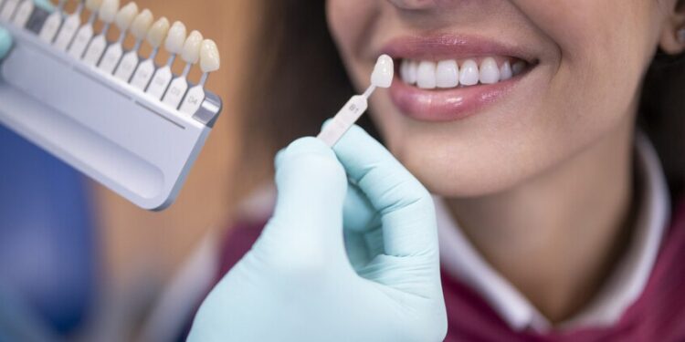 كل ما تحتاج إلى معرفته حول الكسوة الخزفية للأسنان