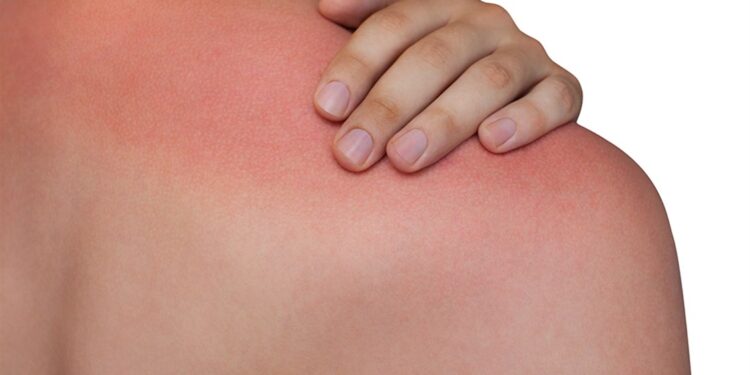 الإسعافات الأولية الضرورية عند التعرض لحروق الشمس .