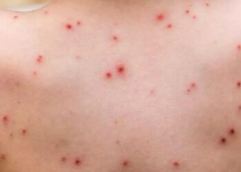 تسجيل حالة إصابة مؤكدة بمرض جدري القردة بمراكش