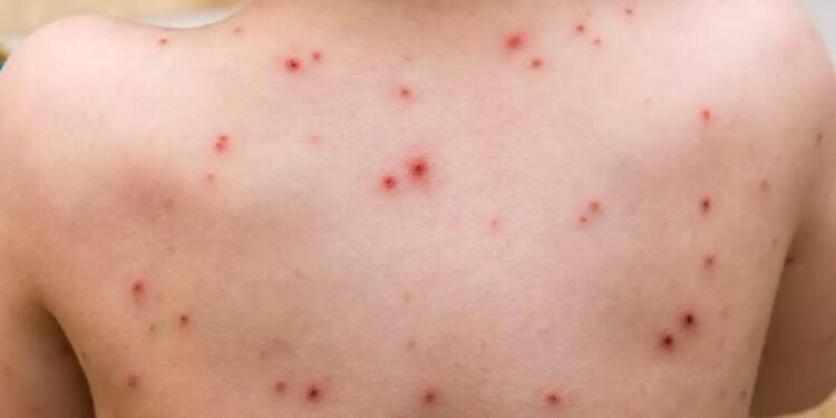 تسجيل حالة إصابة مؤكدة بمرض جدري القردة بمراكش