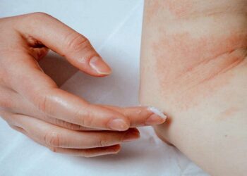 أسباب الأكزيما وطرق علاجها