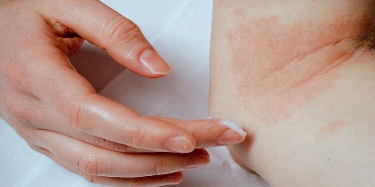 أسباب الأكزيما وطرق علاجها