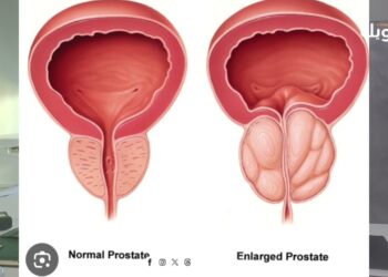 اختصاصي في جراحة المسالك البولية يتحدث عن مرض شائع بنسبة كبيرة بين الرجال فوق 60 عامًا.